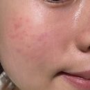 아그네스 레이저 후기 궁금해서 열심히 찾아본 썰