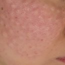 올하트성형외과의원 | [공지] 메이트성형외과 눈성형 상담 &amp; 리쥬란힐러 내돈내산 후기