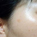 신사역)내돈내산 엑셀브이 색소모드(딱지레이저...입꼬리 보톡스까지!당일~7일차 후기 신사넘버파이브의원