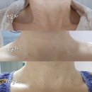 광주 편평사마귀 제거 각화동 피부관리 에이치앤에이치더바디 플라즈마 후기