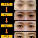 쌍수 라인 연예인라인 : 인아웃라인 후기