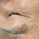 중리동 피부관리 슈퍼젝션 레티나로이드 탄력관리 후기