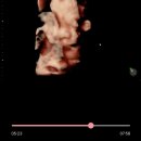 소망약국 | 임신 34주 차 증상 자궁경부 길이 미즈메디 후기 정밀 초음파