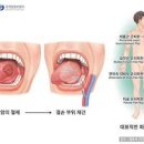 설암 이미지