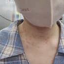세보한의원 | 목동 한의원 편평사마귀 제거 거우침(a.k.a 불고문ㅜㅜ) 시술 후기