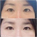 명동시원한의원 | 눈밑고랑꺼짐필러(울트라콜200) 시술 2개월 후기