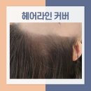 남양주 섬세한 터치로 완벽 헤어라인 커버 후기