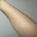 (주)유케이 | 임산부 여드름/등드름 없애기 -유케이스크럽 (임산부 실사용후기)