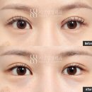 [시선성형외과] 뒤밑트임 하나로 꼬막눈·작은눈·함몰눈이 얼마나 달라질까? (+사례 모음)