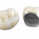 송도스카이치과의원 | 송도 치과 의원 - 심한 이갈이가 의심되는 치아 파절 &amp; PFM 보철 마모 크라운 수복