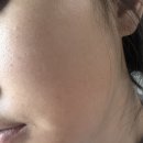 리프탑의원 리쥬란 후기