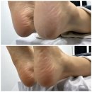 리턴스킨 | 산본 발각질 고민 끝! 리턴스킨 패디플래닝으로 아기 발 된 리얼 후기 (산본 발각질관리)