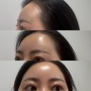 이유의원 | 내돈내산 김송이의원 이마필러&amp;미간보톡스 후기 +레스틸렌 추천 이유