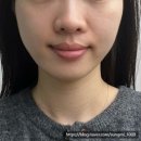 티타늄리프팅 가격 유지기간 솔직후기