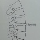 spurring 뼈 돌기 생성 이미지