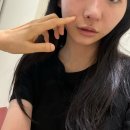 청담아르티의원 레디어스 후기 | 팔자주름과 인디언주름 개선 리얼 변화