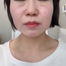 미아사거리 초음파 리프팅 솔직 후기! 턱선이 살아난다