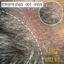 창동007 | 창동 정수리 두피문신 탈모로 고민이라면? 3주 해결방법