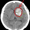 뇌출혈에 대하여 이미지