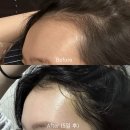 모우림의원 | 압구정역 모발이식 모우림의원 여자 헤어라인 절개 1700모 후기