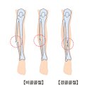 근골격질환인 경골과 비골 골절(Fracture of tibia & fibula)이란? 이미지