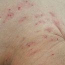 20키로증량이 가져온 불편함 중 일부인 쥐젖 이미지