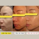 효정에스테틱 | 좁쌀여드름, 요철 일주일만에 해결!!! 코챌라 리얼 후기!!