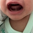 신성메디칼 | 오산 소아과추천_생후 36일차 아기 설소대 시술후기