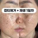 잘 유지되고 있는 기미 주근깨 잡티 올해 한번 더 내돈내산으로 레이저 재생 운정 유온스킨랩 어썸뷰티랩