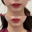 안면비대칭교정 청담역한의원 턱관절치료 FCST&amp;침도요법 1회차 후기_[효과있음]