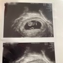 박동 | 임신 9주차 병원 진료 후기｜심장박동 확인·태아 성장 정상·검사 결과 안도