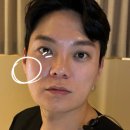 에미뜨의원 | 수원울쎄라 화상 원인? 알려드립니다