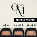 대구 달서구 월성동 smp 잘하는 곳 M자이마 헤어라인 후기