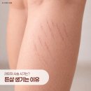 로아르피부과의원 | 온천장튼살 왜 생기는걸까요? 튼살레이저 시술 시기