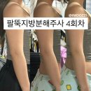 용산비만클리닉 내돈내산 4회차 팔뚝다이어트 지방분해주사 제로팻 후기