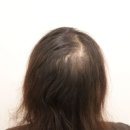 제로잉 | 머리빠짐관리 잘하는 일산두피관리샵 리로잉 일산본점