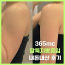 달아래면 | 신사역 365mc강남 팔뚝지방흡입 수술 3차 후기ㅣ오렌지케어 후관리와 한 달 차 변화
