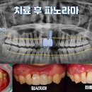 가지런e치과기공소 | 상인동 치과 , 상실된 앞니 임플란트