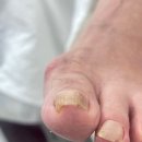 문제성 손, 발 오감네일 이미지