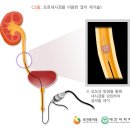 신장결석 [kidney stone , 腎臟結石] 이미지