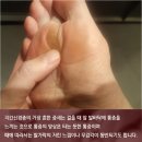 발바닥앞쪽통증 괴로운 지간신경종 해답(解答) 찾는다면 이미지