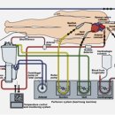 체외순환 (Cardiopulmonary bypass) 이미지