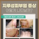 바른샘한의원 네이버블로그