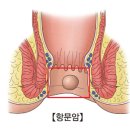 항문암 (Anal cancer) 이미지