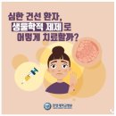 심한 건선 환자, 생물학적 제제로 어떻게 치료할까? 이미지