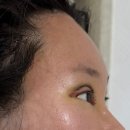 스타트라인 | 이마거상+쌍꺼풀 재재수술 후기_1주차