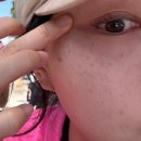 601삼겹살 | 압구정 루비레이저 내돈내산 601방 10개월 지난 비포 애프터 후기 (주근깨 제거)