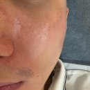 건강생활 신림지점 | 신림피부관리 에스테틱 여운에서 받은 물방울 리프팅 솔직 후기