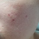 진솔한의원 | [내돈내산] 이대역 사월의봄 한의원 - 새살침 후기(여드름 흉터 채움침2)