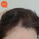 효심한의원 | 암환자 염색약 이문원한의원 새캄 저자극 눈시림NO:유방암 셀프염색 내돈내산 후기